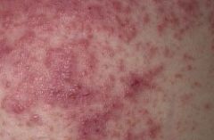 Is It possible To Be allergic To cannabis 3 A case Of severe contact dermatitis showing typical redness And raised bumpy rash 250x163