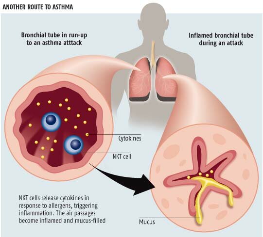 Cannabis-Asthma-1-A-diagram-showing-the-difference-between-a-healthy-bronchial-tube-and-one-undergoing-acute-asthma.jpg