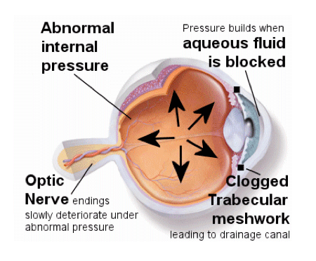 Cannabis-Glaucoma-1-A-diagram-illustrating-the-progression-of-glaucoma.png