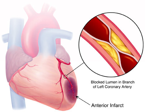 Cannabis-Hypertension-2-Myocardial-infarction-heart-attack-resulting-from-hypertension.jpg