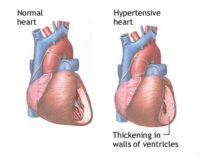 Cannabis-Hypertension-3-Untreated-hypertension-can-lead-to-poor-vascular-health.jpg